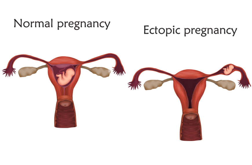 How To Avoid Ectopic Pregnancy With IVF