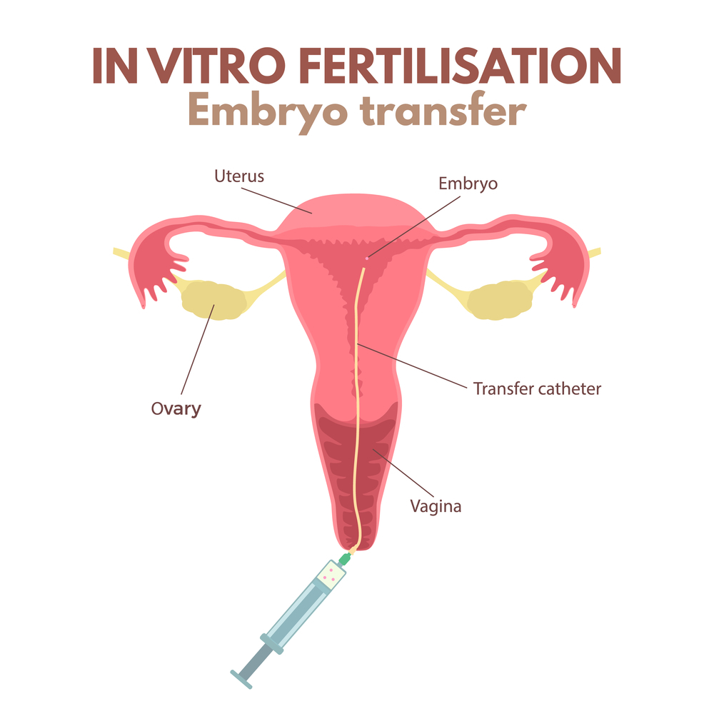 How Many Embryo Transfer In IVF