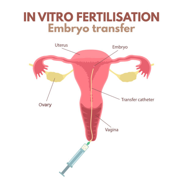 embryo transfer in ivf